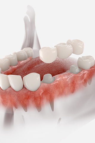 Example of a dental bridge from Forest Falls Dental