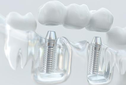 Example of an implant dental bridge from Forest Falls Dental