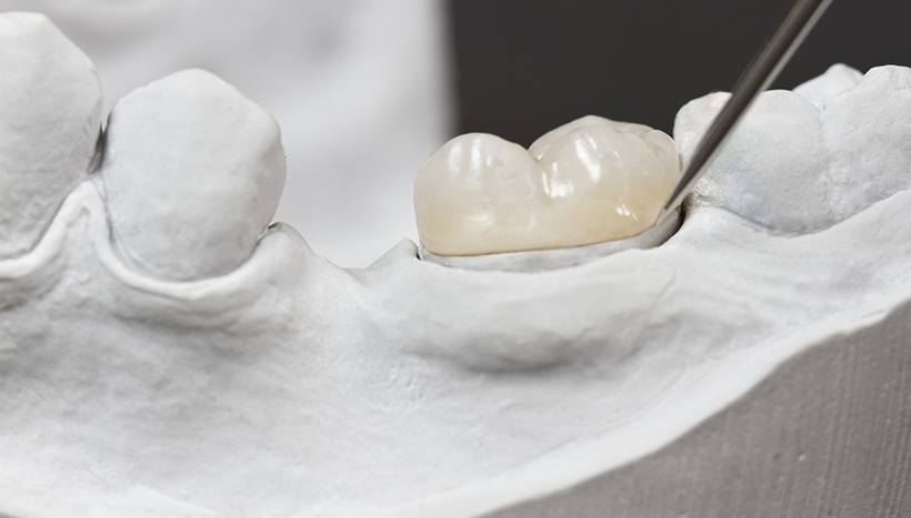 Sample dental crown on cast of teeth