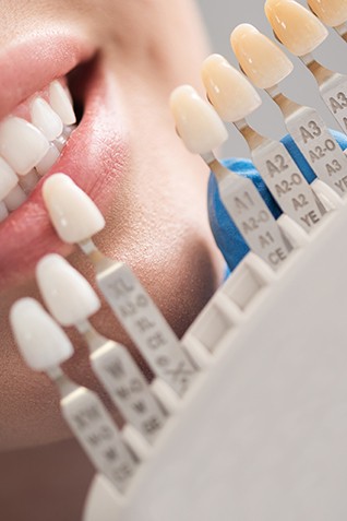 Shade guide held to woman’s teeth