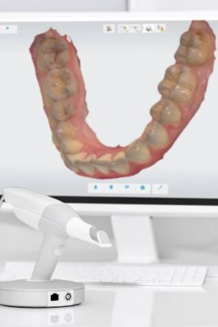 Intraoral camera device in front of computer screen showing digital model of teeth
