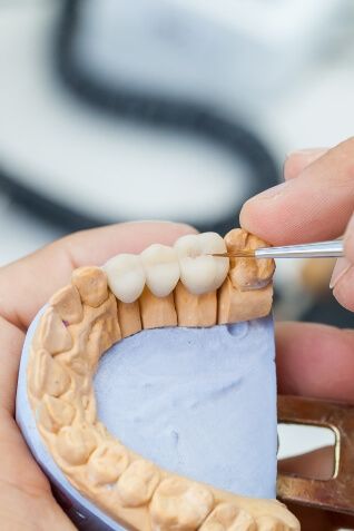 Dentist crafting a dental bridge to replace three missing teeth