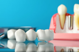 Close up of a dental bridge on a blue background